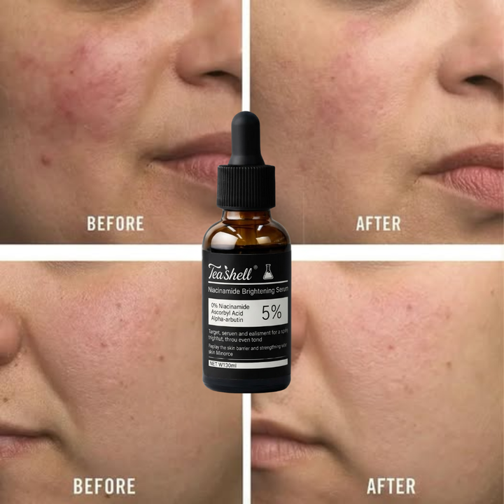Teashell Niacinamide Brightening Serum melasma dark spots freckle face body